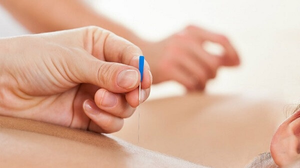 Hiểu về phương pháp cấy chỉ giảm béo