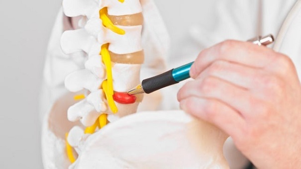 Thoát vị đĩa đệm có nhất thiết phải mổ ?
