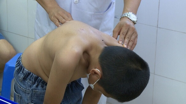 Bài tập cho người bị gù lưng